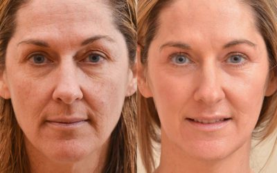 ¿Conoces el rejuvenecimiento facial con láser?