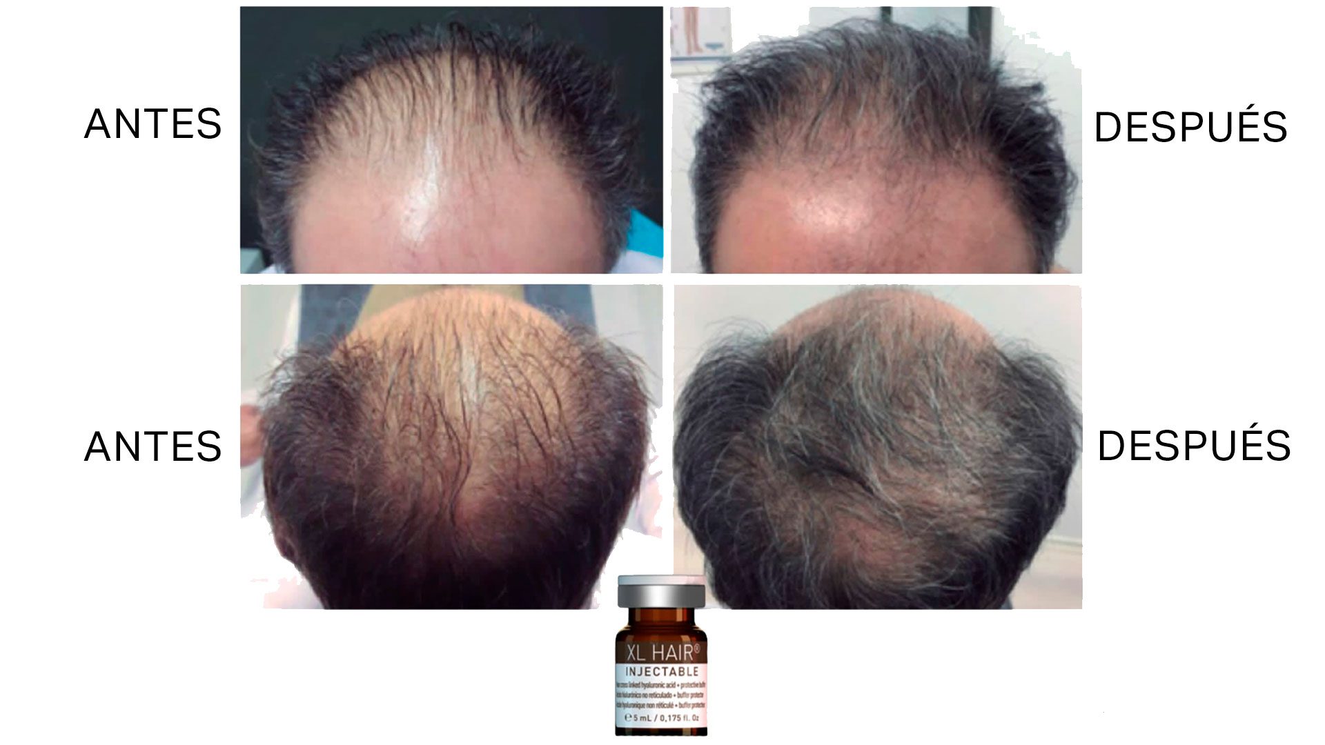 anticaida pelo tarragona-alopecia tratamiento