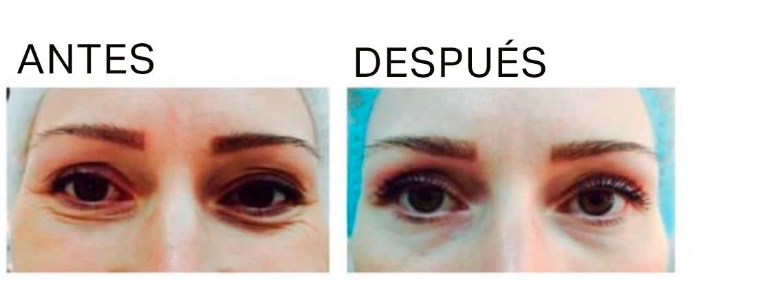 tratamiento arrugas ojos tarragona clinica estetica mei