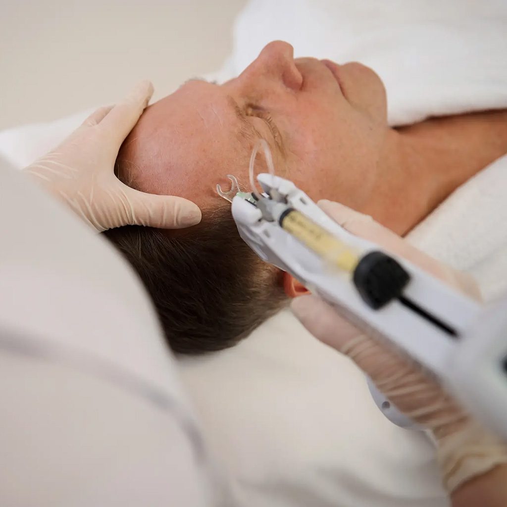 electroporación con Mesoboost Tarragona